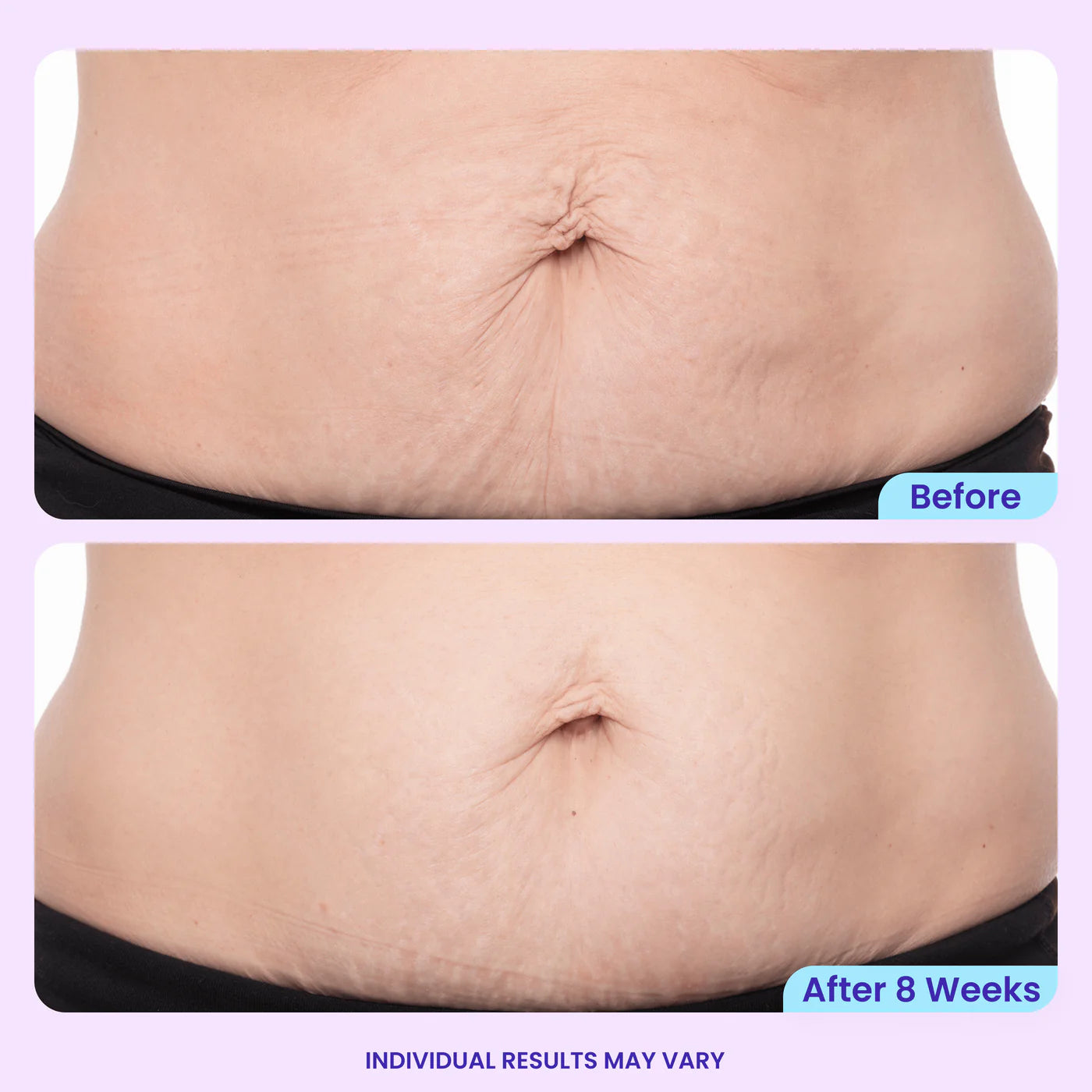 Solysta Belly Cream